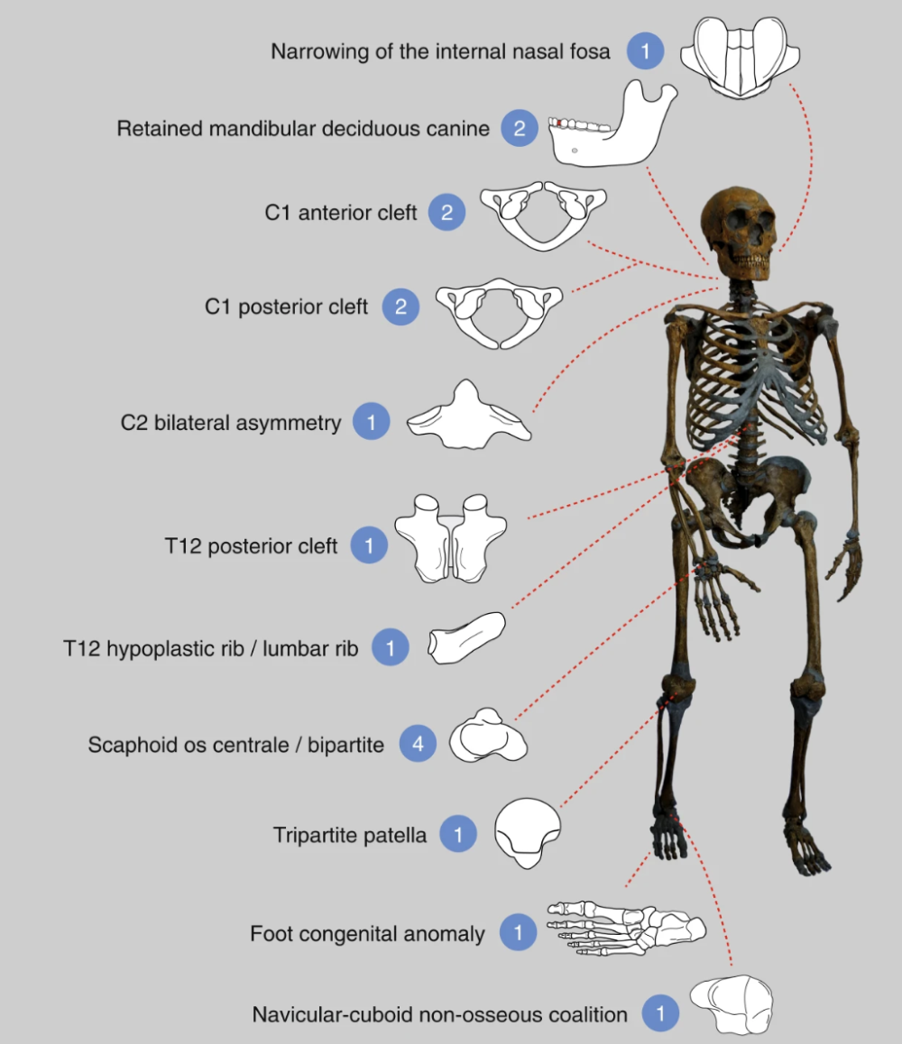 neanderthal inbreeding led to lots of congenital anomalies in neanderthals